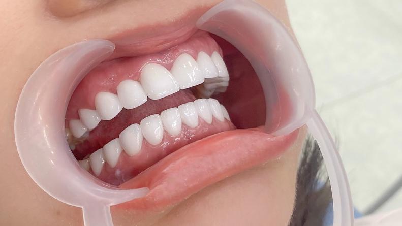 Tại sao bọc răng sứ được ưa chuộng