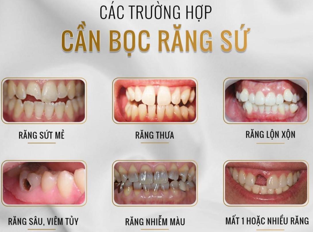 Ai nên bọc răng sứ