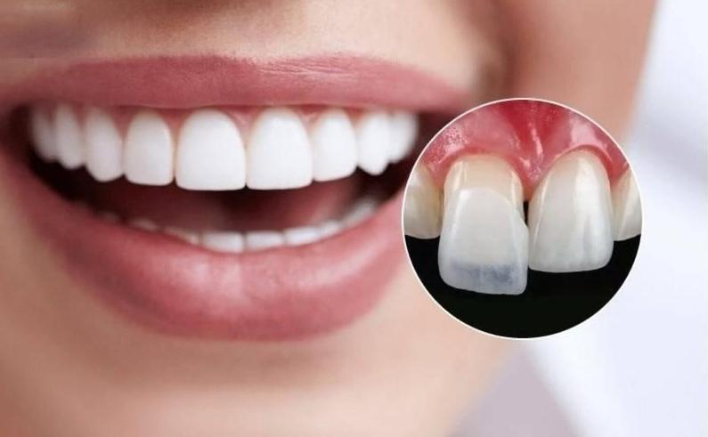 Mặt dán sứ Veneer