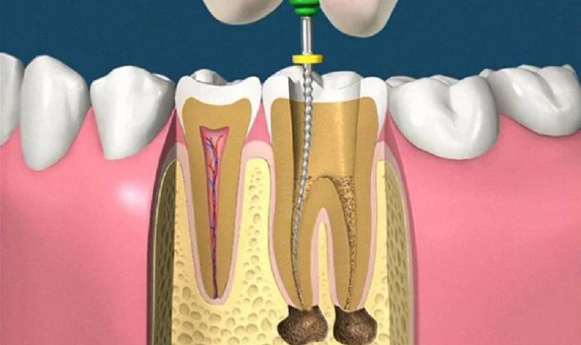 Điều trị và làm sạch tủy