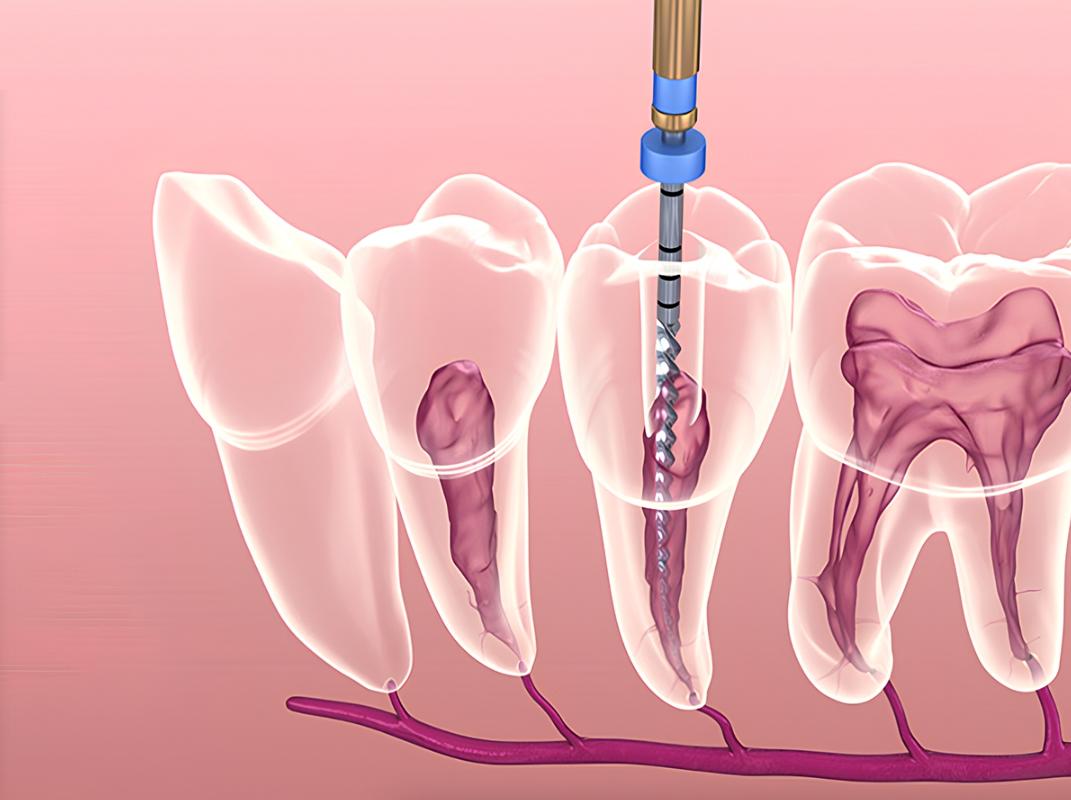 Điều trị tủy răng là gì