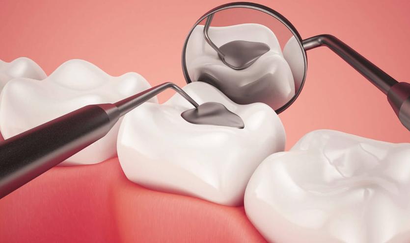 Trám răng thẩm mỹ