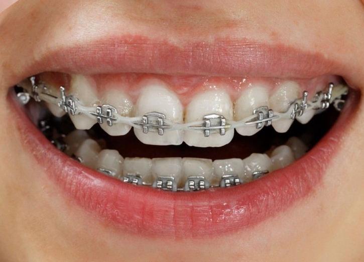 Ai nên niềng răng mắc cài
