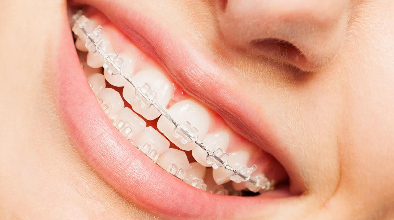 Niềng răng mắc cài sứ
