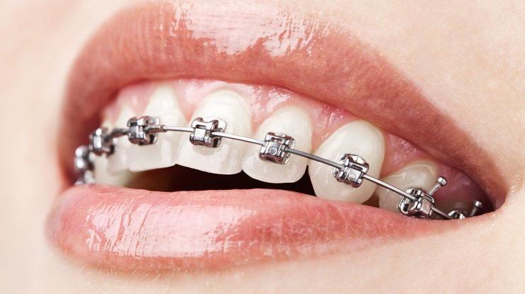 Niềng răng mắc cài là gì