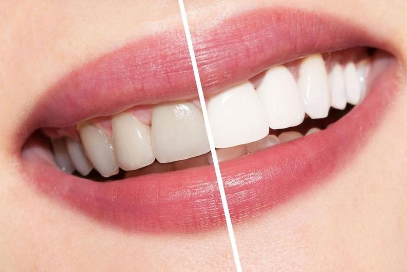 Khi nào nên tẩy trắng răng?