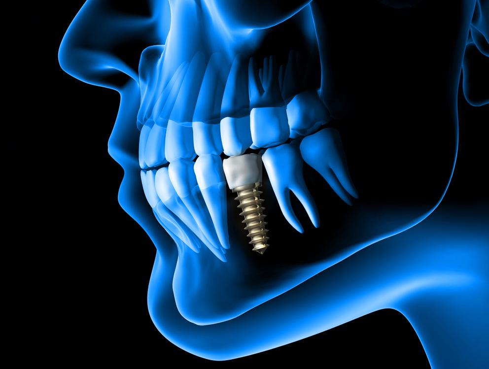 Trồng răng Implant đơn lẻ