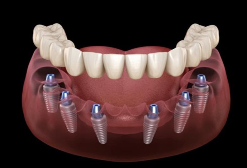Trồng răng Implant toàn hàm