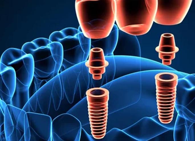 Cầu răng sứ trên Implant