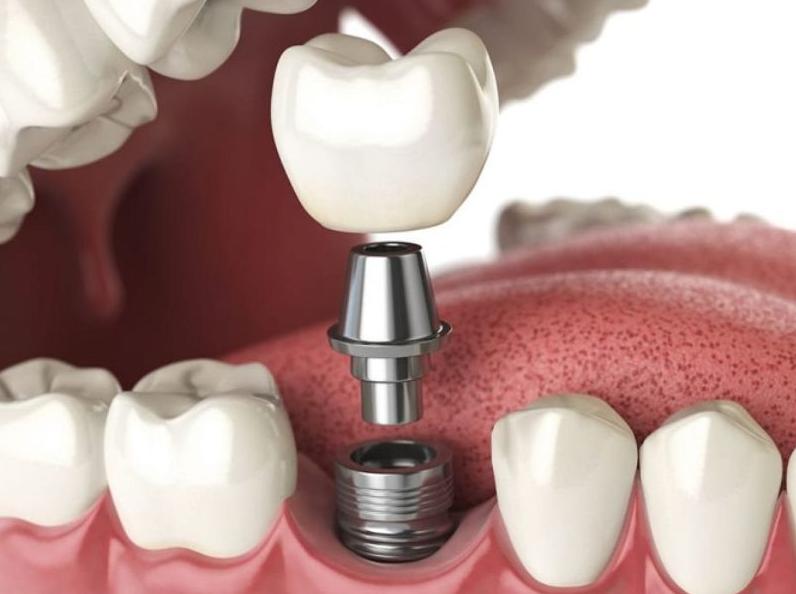 Trồng răng Implant là gì