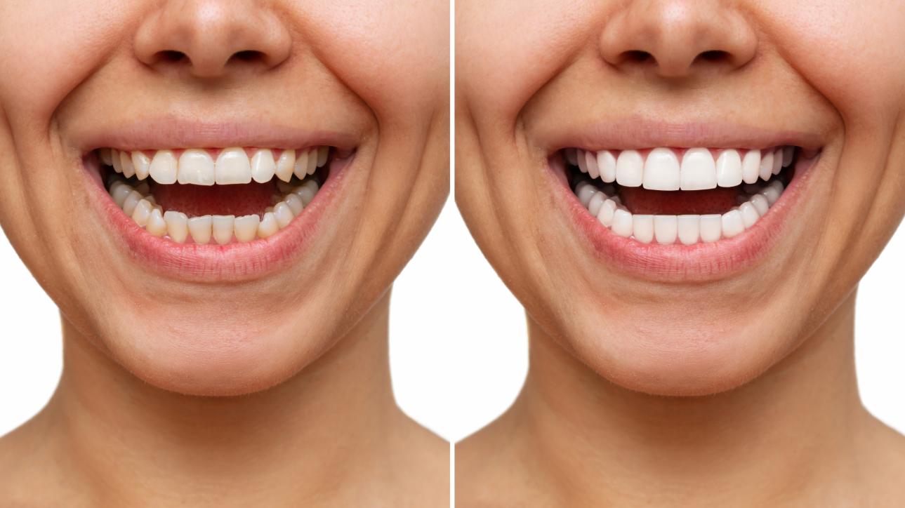 Ưu điểm của dán sứ Veneer