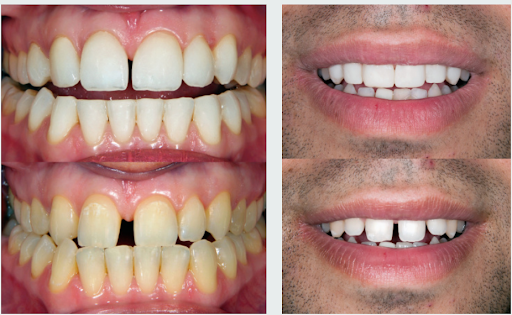 Trường hợp nên dán sứ Veneer