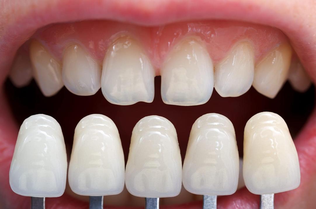 Dán răng sứ Veneer có phải mài răng không?