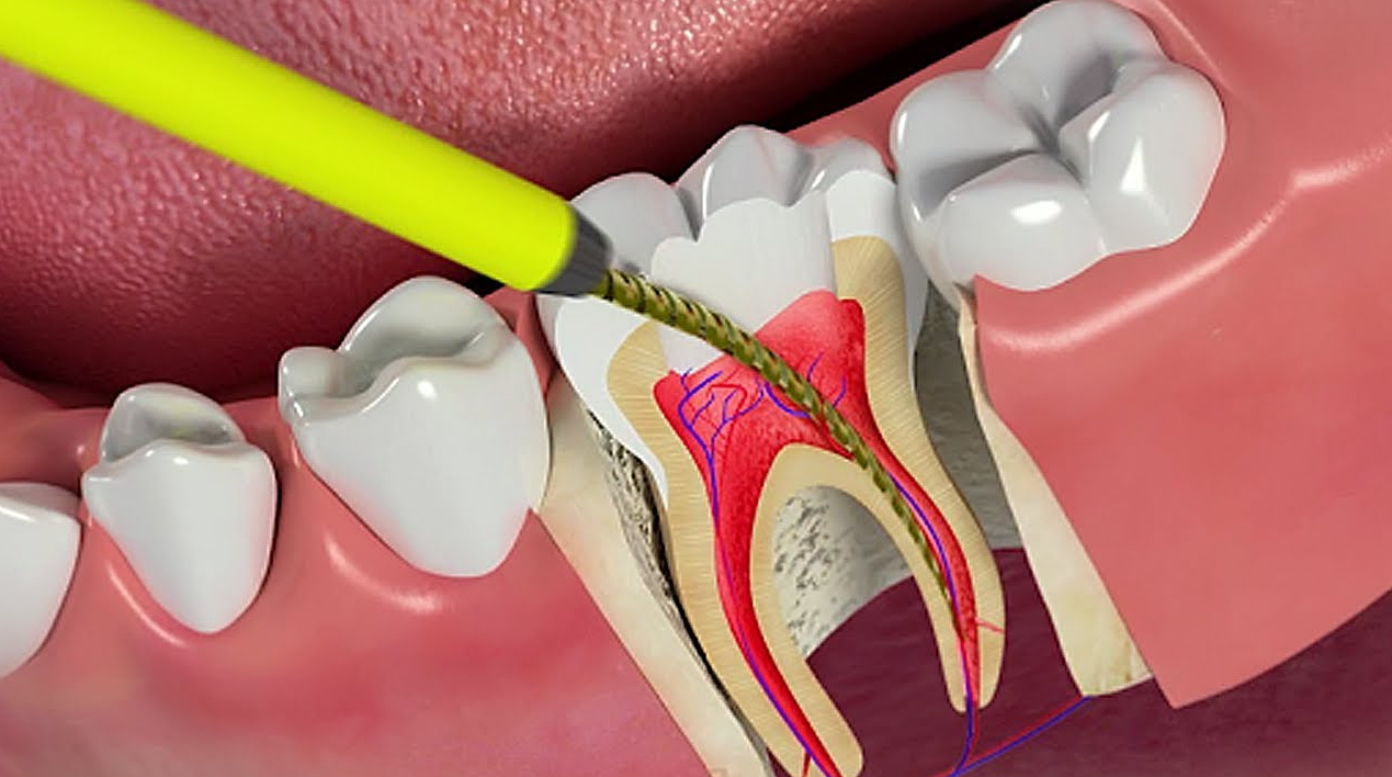Răng đã lấy tủy thì có thực hiện dán sứ Veneer được không