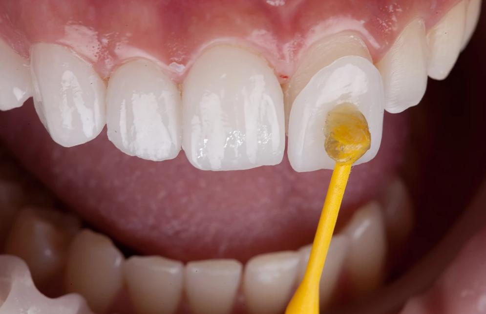 porcelain veneers